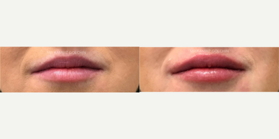 Belotero before and after photo