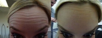 Botox before and after photo