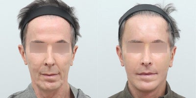 Facelift before and after photo