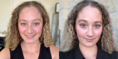 HydraFacial before and after photo