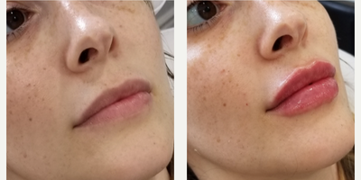 Lip Fillers before and after photo