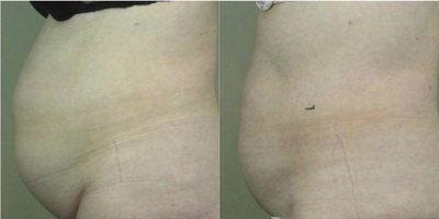 UltraShape before and after photo