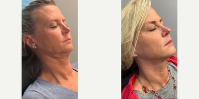 Botox before and after photo