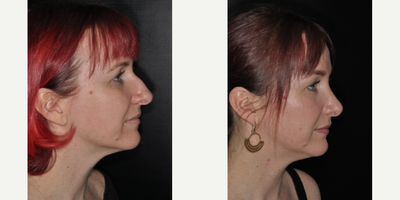 Brow Lift before and after photo