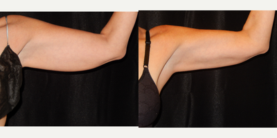 CoolSculpting before and after photo