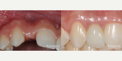 Dental Implants before and after photo