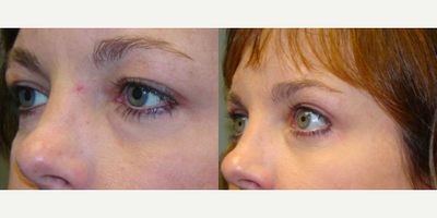 Eyelid Surgery before and after photo