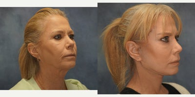 Facelift before and after photo