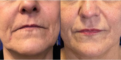 Lip Fillers before and after photo