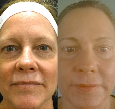 Laser Resurfacing before and after photo