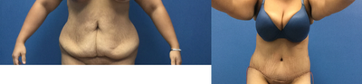 Tummy Tuck before and after photo