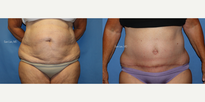 Tummy Tuck before and after photo