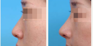 Asian Rhinoplasty before and after photo