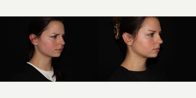 Botox before and after photo