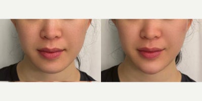 Chin Filler before and after photo