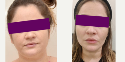 Chin Liposuction before and after photo