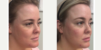 Dermal Fillers before and after photo