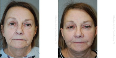 Facelift before and after photo