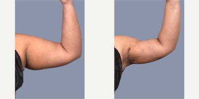Skin Tightening before and after photo