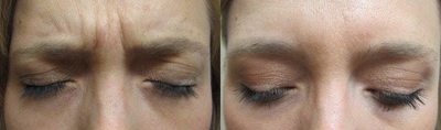 Botox before and after photo