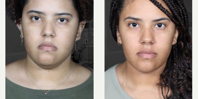 Neck Lift before and after photo