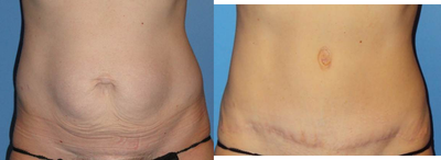 Tummy Tuck before and after photo