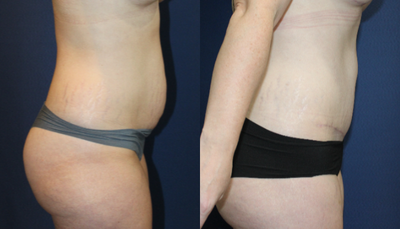Tummy Tuck before and after photo