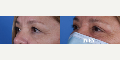 Eyelid Surgery before and after photo