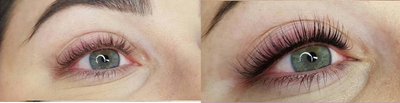 Latisse before and after photo