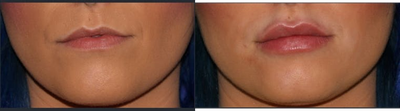 Lip Fillers before and after photo