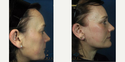 Neck Lift before and after photo
