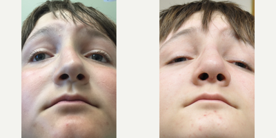 Rhinoplasty before and after photo