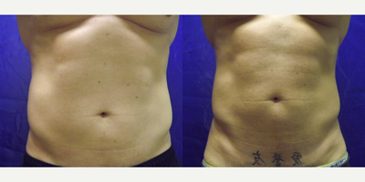 Vaser Liposuction before and after photo