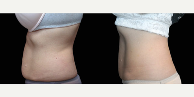 Emsculpt before and after photo