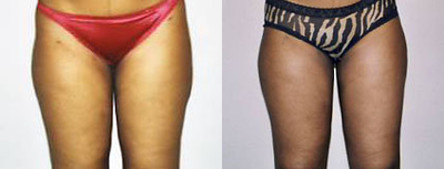 Liposuction before and after photo