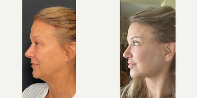 Deep Plane Facelift before and after photo