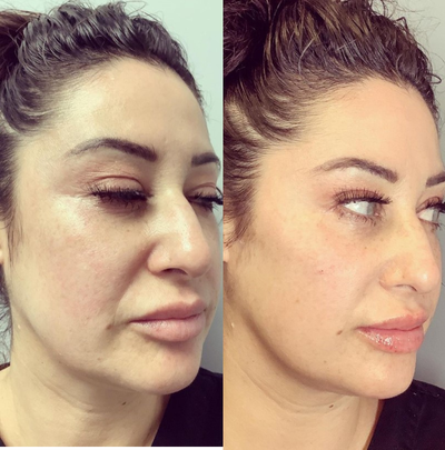 Dermal Fillers before and after photo