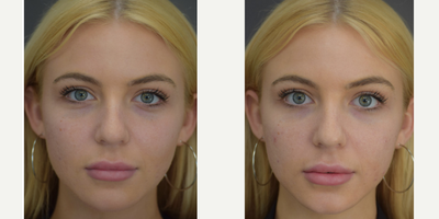 Eyelid Surgery before and after photo