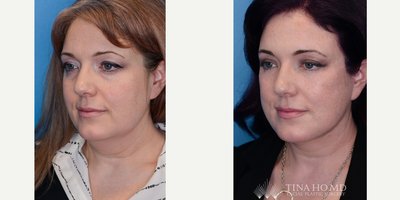 Facial Fat Transfer before and after photo
