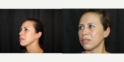 Halo Laser before and after photo