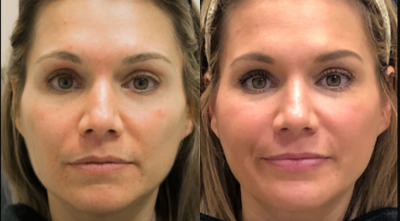 Lip Lift before and after photo