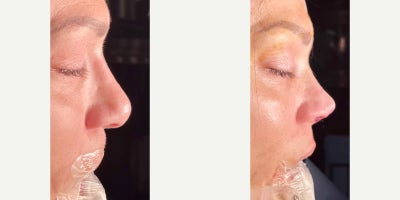 Revision Rhinoplasty before and after photo