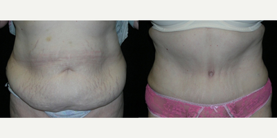 Tummy Tuck before and after photo