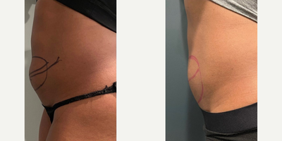 CoolSculpting before and after photo