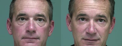 Eyelid Surgery before and after photo