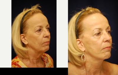 Facelift before and after photo
