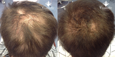 PRP for Hair Loss before and after photo