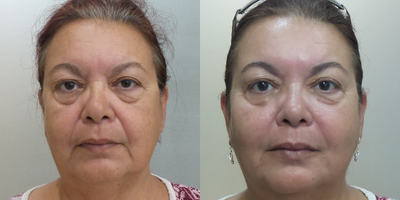 Radiesse before and after photo