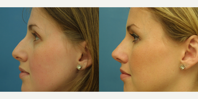 Rhinoplasty before and after photo