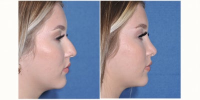 Rhinoplasty before and after photo